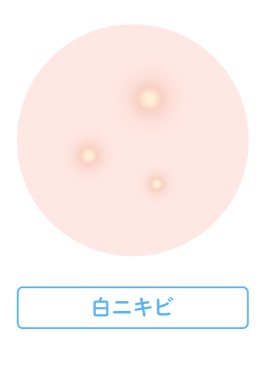 白ニキビ