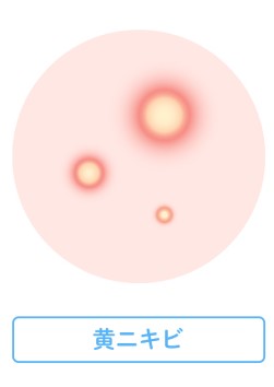 黄ニキビ