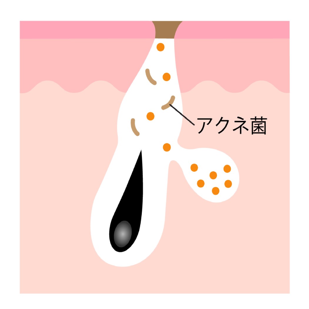 芯のある形状のおでこニキビ