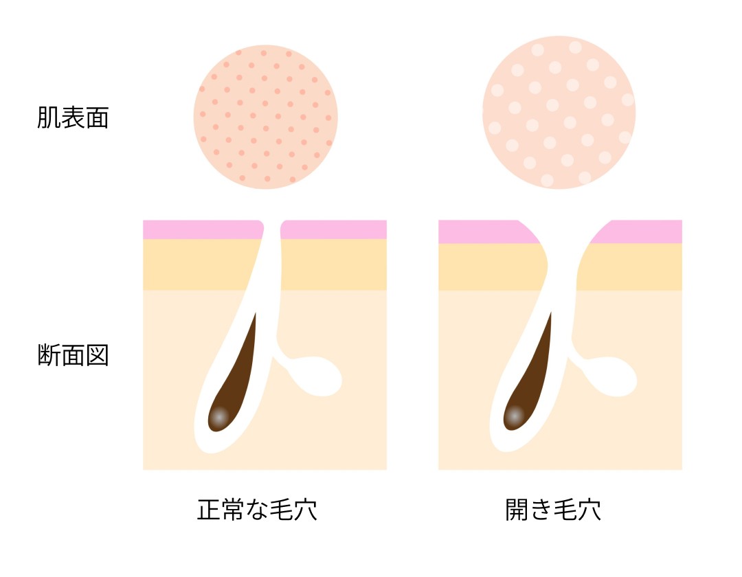 開き毛穴　断面図