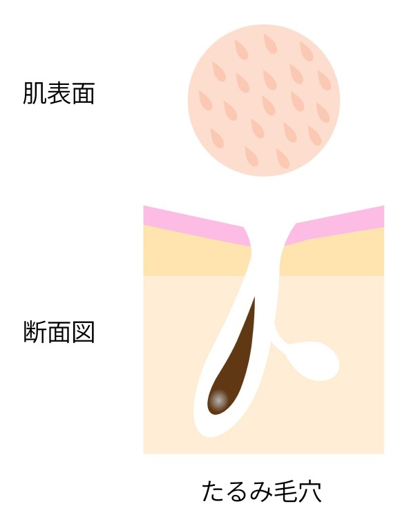 たるみ毛穴　断面図