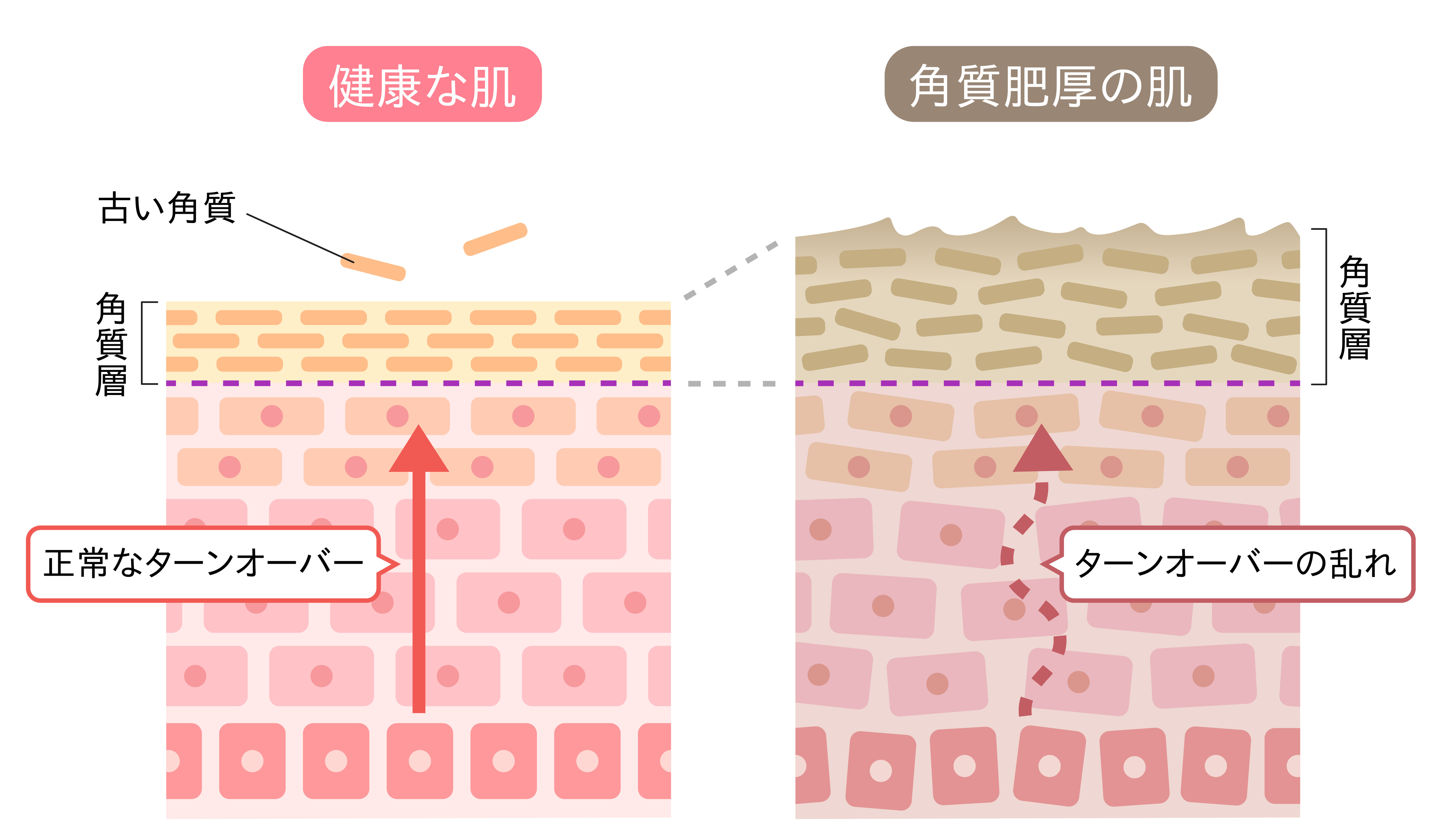 健康な肌：正常なターンオーバー　角質肥厚の肌：ターンオーバーの乱れ