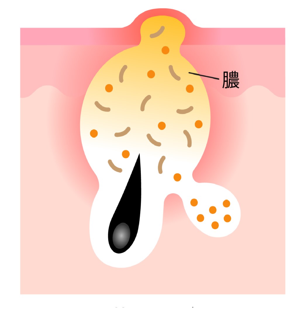 思春期にできる膿を持ったニキビ