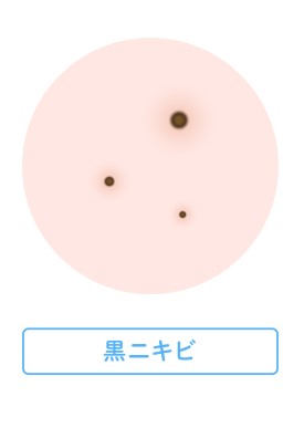 黒ニキビ