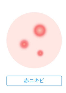 赤ニキビ