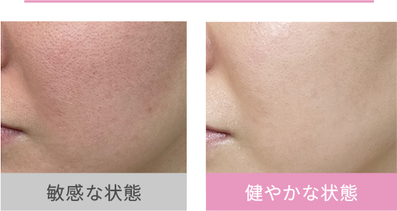 敏感肌ってどういう状態？ 肌のバリア機能が低下している状態です。毎日調子の良い肌を目指しましょう！ 敏感な状態 健やかな状態