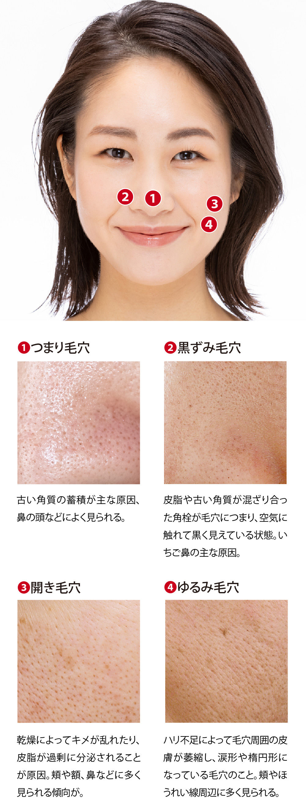 【つまり毛穴】古い角質の蓄積が主な原因、鼻の頭などによく見られる。　【黒ずみ毛穴】皮脂や古い角質が混ざり合った角栓が毛穴につまり、空気に触れて黒く見えている状態。いちご鼻の主な原因。　【開き毛穴】乾燥によってキメが乱れたり、皮脂が過剰に分泌されることが原因。頬や額、鼻などに多く見られる傾向が。　【ゆるみ毛穴】ハリ不足によって毛穴周囲の皮膚が萎縮し、涙形や楕円形になっている毛穴のこと。頬やほうれい線周辺に多く見られる。