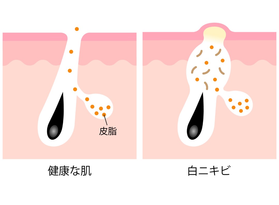 健康な肌と過剰な皮脂が詰まりニキビになる図