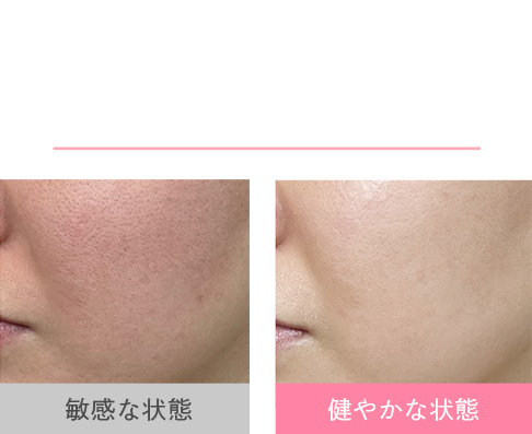 敏感肌ってどういう状態? 肌のバリア機能が低下している状態です。毎日調子の良い肌を目指しましょう! 敏感な状態 健やかな状態